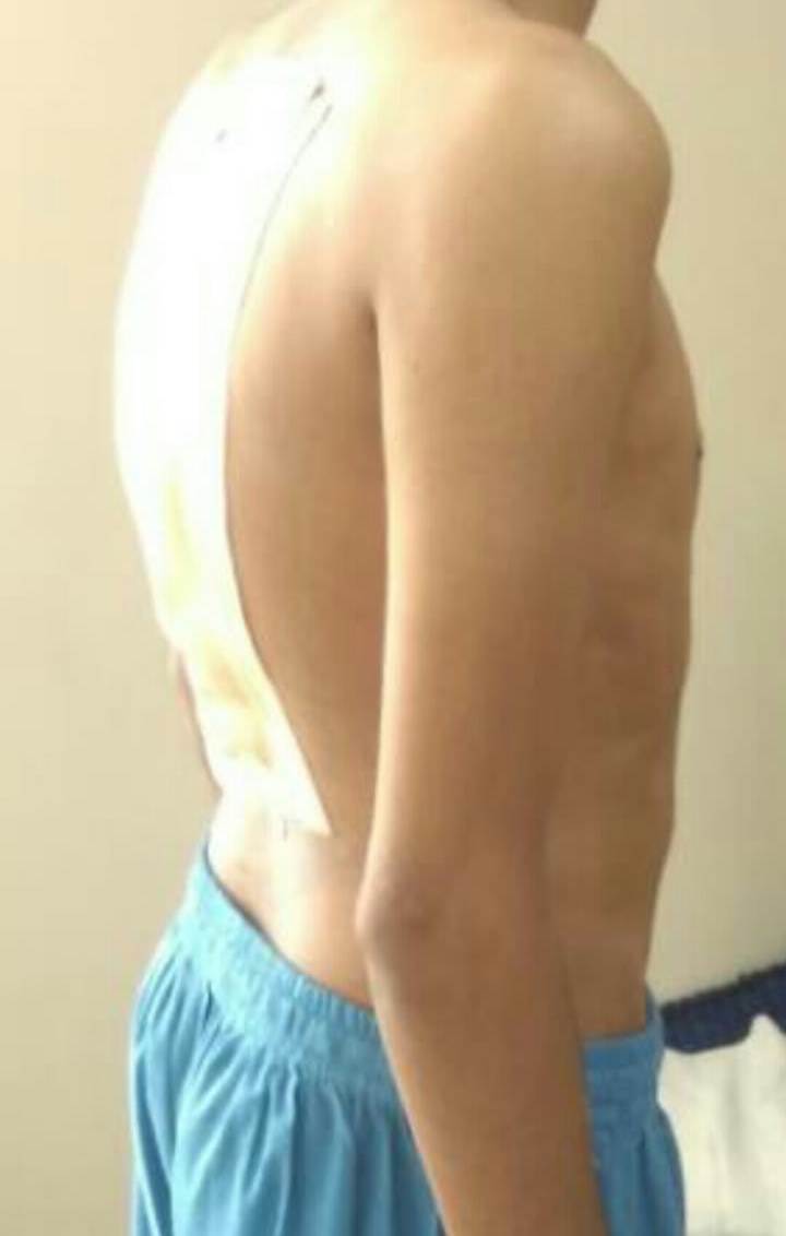 cervical