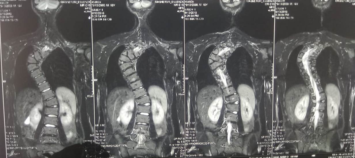 cervical
