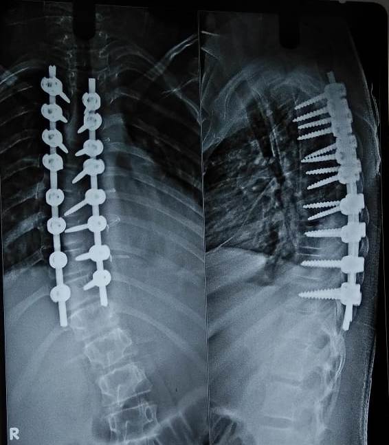 cervical