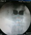 odontoid