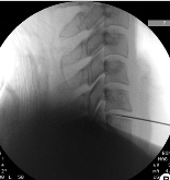odontoid