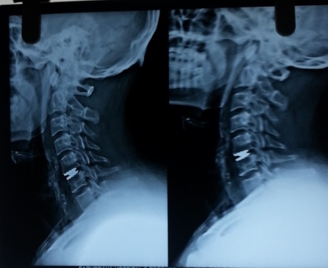 cervical