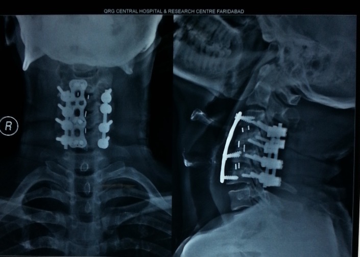 cervical