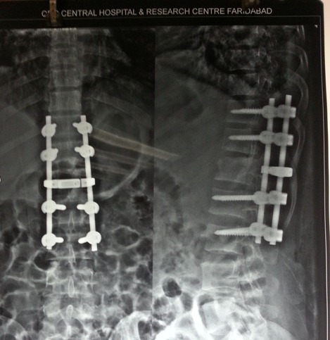 lumbar