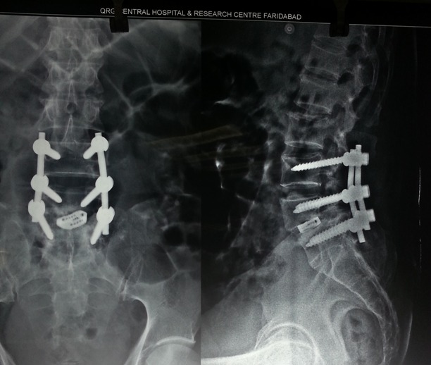lumbar