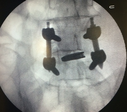 lumbar
