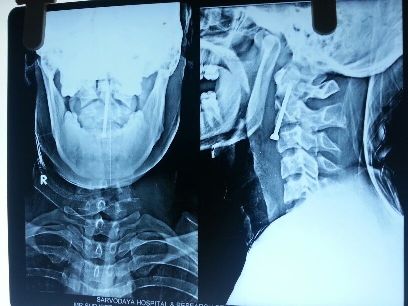 odontoid